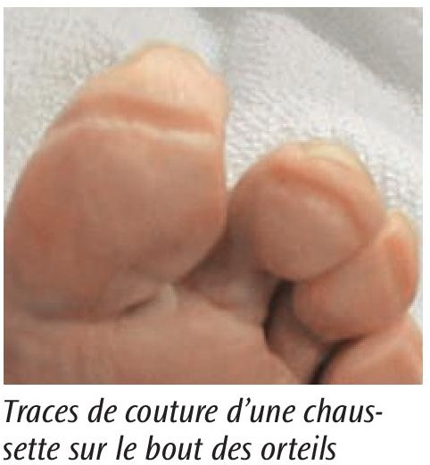 Traces de couture d'une chaussette sur le bout des orteils